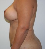 Liposuction