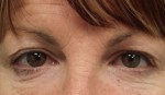 Eyelid Surgery (Blepharoplasty)