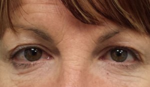 Eyelid Surgery (Blepharoplasty)