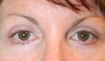 Eyelid Surgery (Blepharoplasty)