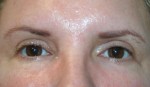 Eyelid Surgery (Blepharoplasty)