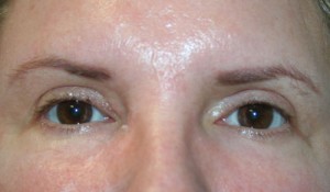 Eyelid Surgery (Blepharoplasty)