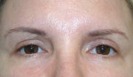 Eyelid Surgery (Blepharoplasty)