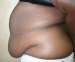 Tummy Tuck (Abdominoplasty)