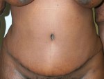 Tummy Tuck (Abdominoplasty)
