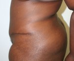 Tummy Tuck (Abdominoplasty)