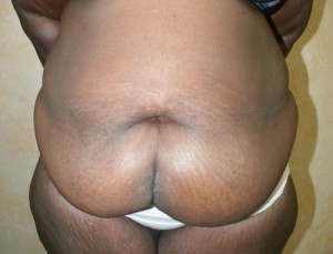 Tummy Tuck (Abdominoplasty)