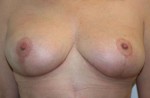 Breast Lift (Mastopexy)