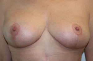 Breast Lift (Mastopexy)