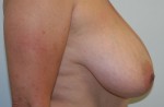 Breast Lift (Mastopexy)