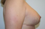 Breast Lift (Mastopexy)