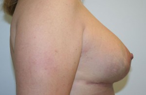 Breast Lift (Mastopexy)