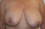 Breast Lift (Mastopexy)