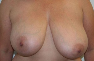 Breast Lift (Mastopexy)