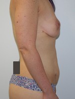 Tummy Tuck (Abdominoplasty)
