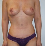 Tummy Tuck (Abdominoplasty)