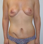 Tummy Tuck (Abdominoplasty)