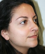 Nose Surgery (Rhinoplasty)