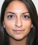 Nose Surgery (Rhinoplasty)
