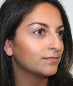 Nose Surgery (Rhinoplasty)