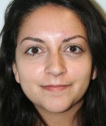 Nose Surgery (Rhinoplasty)