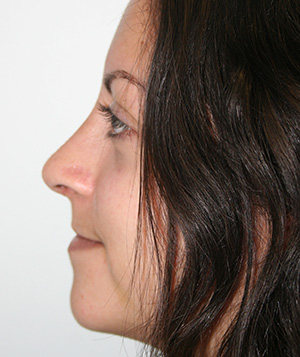 Nose Surgery (Rhinoplasty)