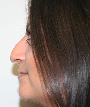 Nose Surgery (Rhinoplasty)