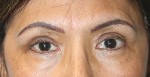 Eyelid Surgery (Blepharoplasty)