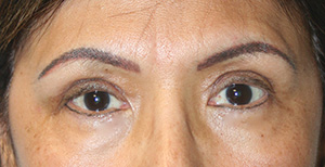 Eyelid Surgery (Blepharoplasty)