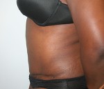 Tummy Tuck (Abdominoplasty)