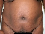 Tummy Tuck (Abdominoplasty)