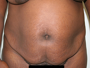 Tummy Tuck (Abdominoplasty)
