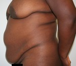 Tummy Tuck (Abdominoplasty)