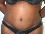 Tummy Tuck (Abdominoplasty)