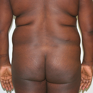Buttock Augmentation