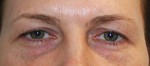 Eyelid Surgery (Blepharoplasty)