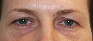 Eyelid Surgery (Blepharoplasty)