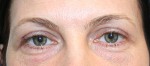 Eyelid Surgery (Blepharoplasty)