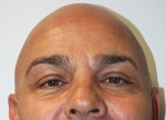 Eyelid Surgery (Blepharoplasty)