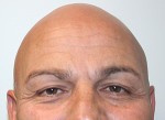 Eyelid Surgery (Blepharoplasty)