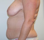 Tummy Tuck (Abdominoplasty)