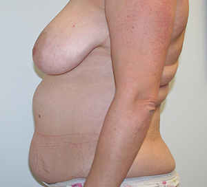 Tummy Tuck (Abdominoplasty)