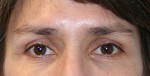 Eyelid Surgery (Blepharoplasty)