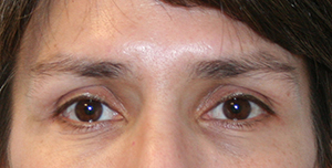 Eyelid Surgery (Blepharoplasty)