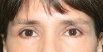 Eyelid Surgery (Blepharoplasty)