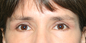 Eyelid Surgery (Blepharoplasty)