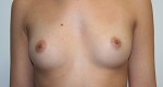Breast Augmentation