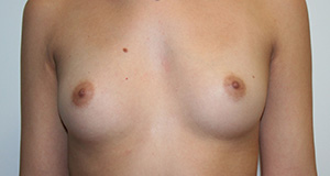 Breast Augmentation