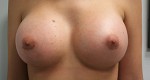 Breast Augmentation