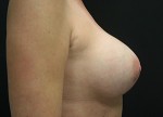 Breast Augmentation
